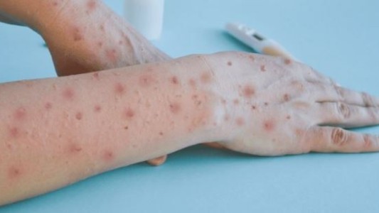 Viruela símica: España reforzará la vacunación y vigilancia ante la emergencia internacional