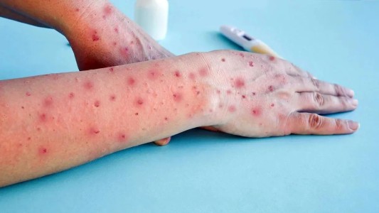 La UNR realizará testeos para diagnosticar la Viruela de Mono