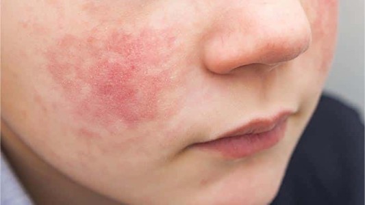 Genodermatosis: el poder del diagnóstico precoz