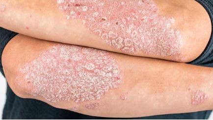 800 mil personas viven con psoriasis en Argentina