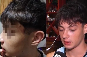 Robo violento: desfiguraron a un joven para quitarle el celular