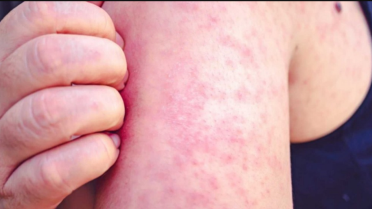 "El brote de sarampión es porque no nos vacunamos", aseguró el infectólogo Hugo Pizzi