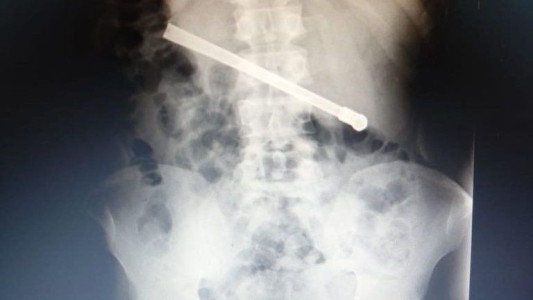 Interno condenado por abuso sexual fue operado tras ingerir una bombilla