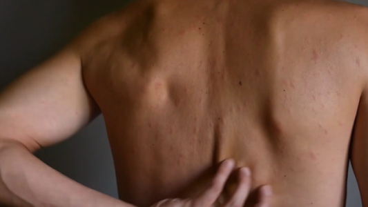 Alerta sanitaria: aumentan los casos de sarampión