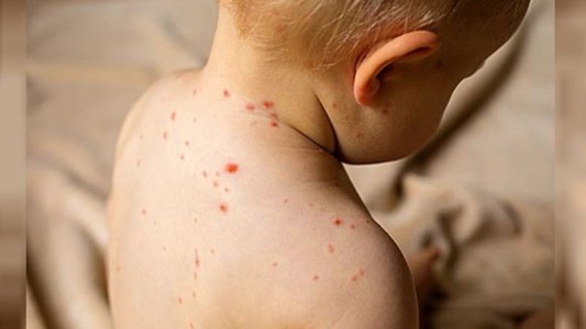 Atención: Detectados Nuevos Brotes de Sarampión