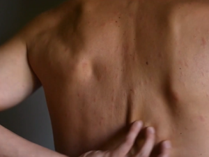 Alerta sanitaria: aumentan los casos de sarampión